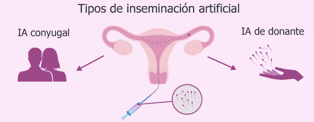 tipos de inseminación artificial